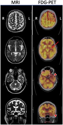 A Novel TBK1 Variant (Lys694del) Presenting With Corticobasal Syndrome in a Family With FTD-ALS Spectrum Diseases: Case Report